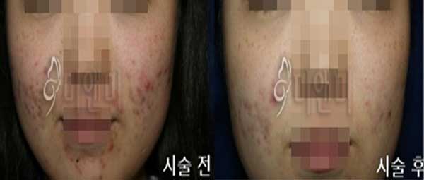 [시술전후사진]여드름+흉터 시술전후