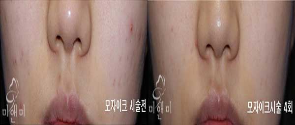 [시술전후사진]여드름/흉터치료 모자이크 시술전후사진